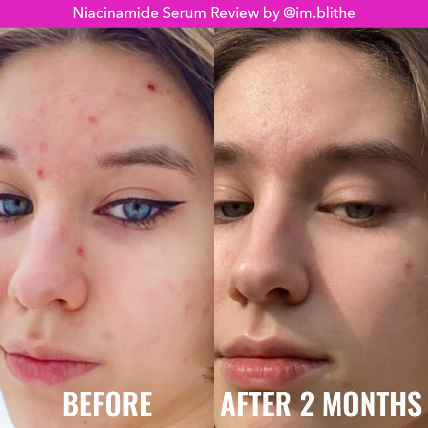 Niacinamide Acid Serum | Serúm de niacinamina